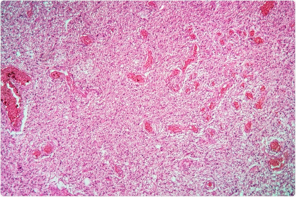 Glioma