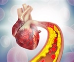 Risks and Side Effects of Heart Stents