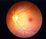New study identifies potential enzyme target for diabetic retinopathy