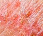 Nitric Oxide as a Treatment for Eczema / Other Skin Conditions