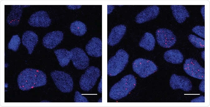 Cells that will eventually become neurons (neural progenitor cells) derived from individuals with autism spectrum disorder, shown in the right panel, exhibit increased DNA damage detected by ?H2AX, shown in the red stain, compared to those derived from healthy individuals (left panel). Image Credit: Salk Institute