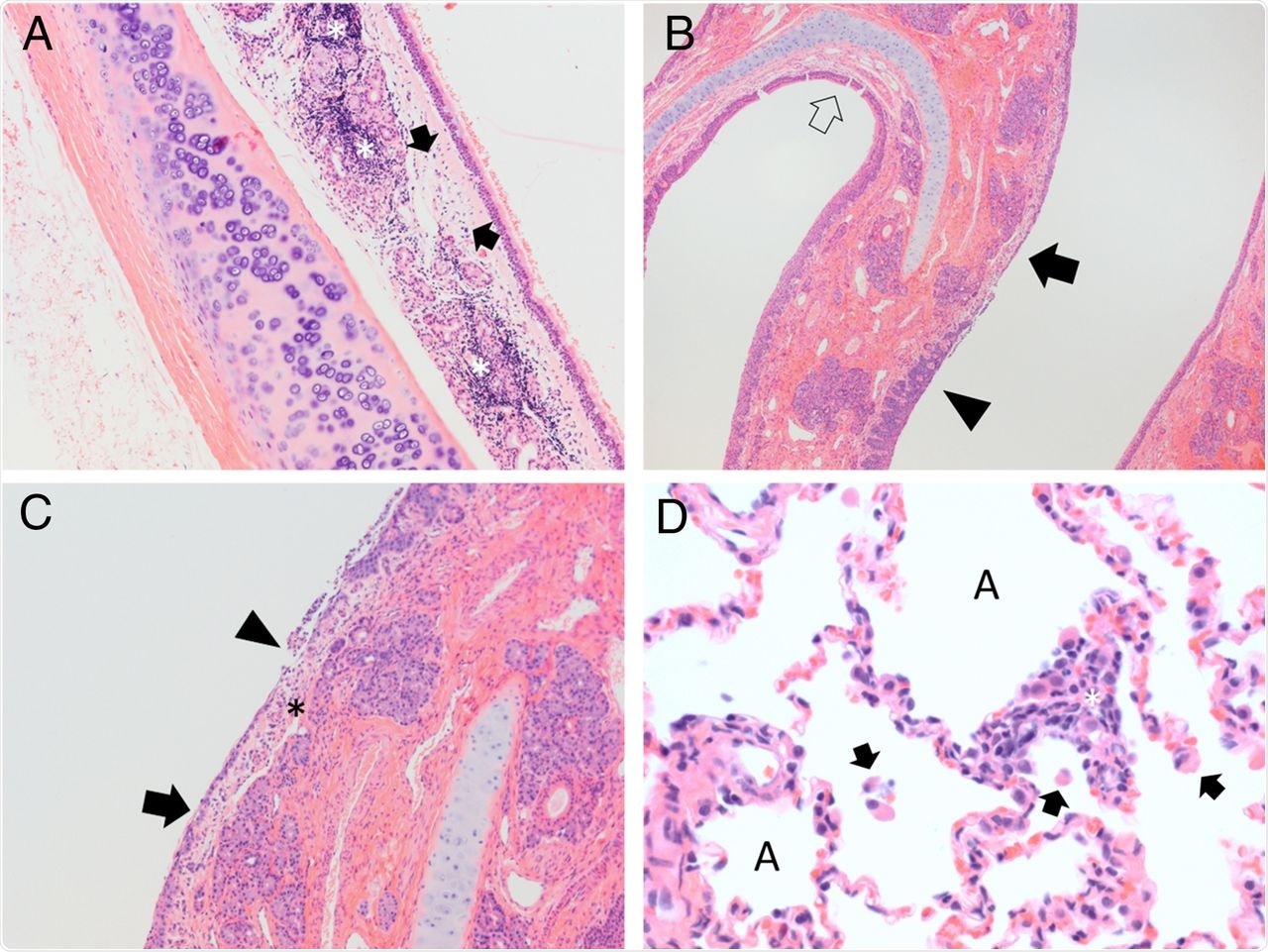 SARS-CoV-2 exposure results in acute upper respiratory inflammation and mild lung infiltrates during later courses of infection. (A) Cat 4, cohort 2, trachea 5 DPI. The submucosa is expanded by edema (arrows) and abundant lymphocytic inflammatory infiltrates (asterisks) which dissect and disrupt submucosal glands. H&E stain, 100× magnification. (B) Cat 5, cohort 2, nasal turbinates, 5 DPI. Normal thickness respiratory mucosa is present in the section (open arrow). Nasal respiratory epithelium ranges from hyperplastic (filled black arrow) to ulcerated (arrowhead). The submucosa in regions of ulceration is edematous and infiltrated by scattered neutrophils and mononuclear cells. H&E stain, 40× magnification. (C) Cat 5, cohort 2, nasal turbinates, 5 DPI. Nasal respiratory epithelium ranges from attenuated (arrow) to ulcerated (arrowhead) with overlying remnant cellular debris. The submucosa (asterisk) in regions of ulceration is edematous and infiltrated by scattered neutrophils and mononuclear cells. H&E stain, 100× magnification. (D) Cat 1, cohort 1, lung, 42 DPI. Alveolar spaces (“A”) contain scattered mononuclear cells (arrows). The alveolar wall is expanded by mixtures of mononuclear cells and occasional neutrophils (asterisk). H&E stain, 400× magnification.