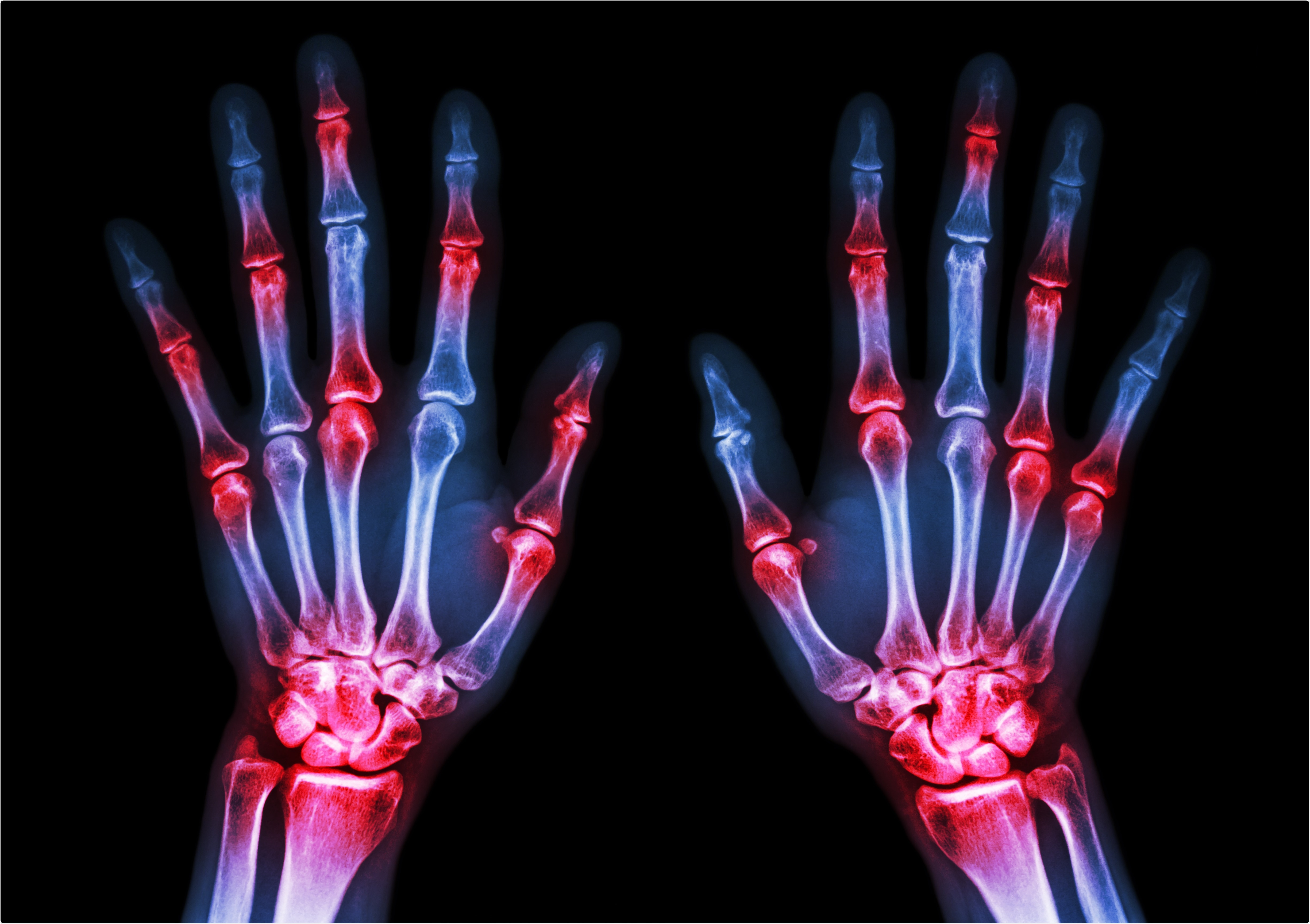 Study: Gout, rheumatoid arthritis and the risk of death from COVID-19. Image Credit: Puwadol Jaturawutthichai / Shutterstock
