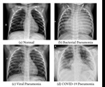 Transfer learning exploits chest-Xray to diagnose COVID-19 pneumonia