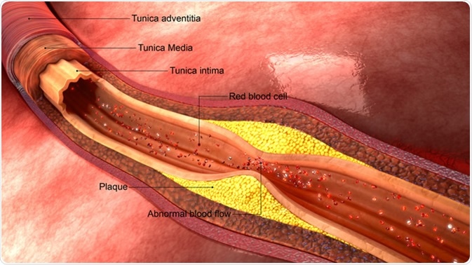 Atherosclerosis 3d illustration. Credit: Sciencepics / Shutterstock