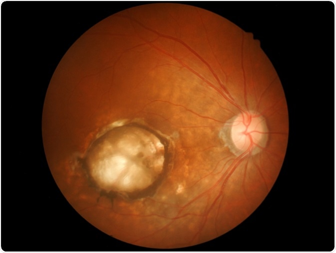 Macular Degneration Macular Degneration