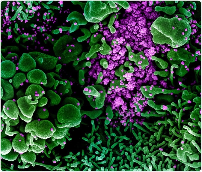 Novel Coronavirus SARS-CoV-2 Colorized scanning electron micrograph of an apoptotic cell (green) heavily infected with SARS-COV-2 virus particles (purple), isolated from a patient sample. Image captured and color-enhanced at the NIAID Integrated Research Facility (IRF) in Fort Detrick, Maryland. Credit: NIAID
