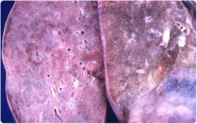 Diffuse alveolar damage (DAD) The lung on the left is diffusely consolidated and pale in appearance. The lung on the right is from another case; it exhibits no significant abnormality and is included for comparison