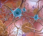 Restoring brain energy balance reverses advanced Alzheimer’s disease in mouse models
