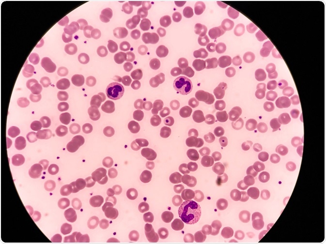 neutropenia