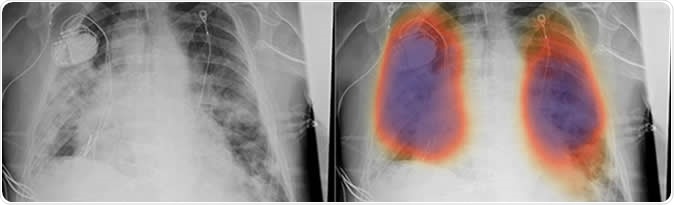 Chest X-rays from a patient with COVID-19 pneumonia, original x-ray (left) and AI-for-pneumonia result (right). Patient has a pacemaker device and an enlarged heart, which indicates that the AI algorithm is powerful enough to work even when the patient has underlying health issues.