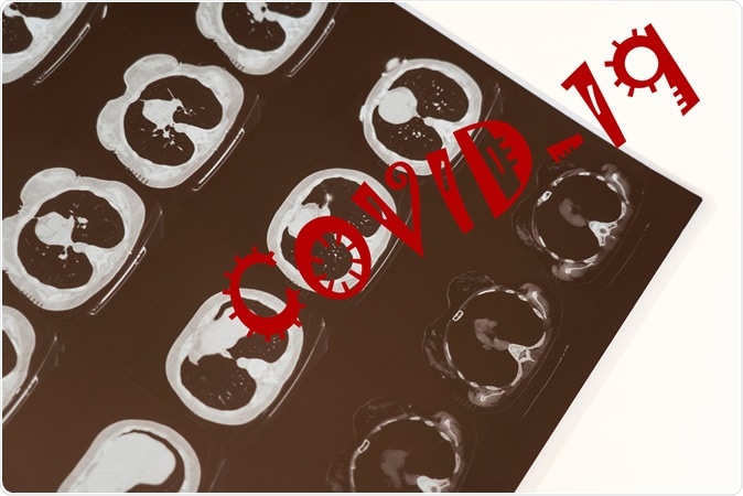 Association of radiologic findings with mortality of patients infected with 2019 novel coronavirus in Wuhan, China. Image Credit: Travel Faery / Shutterstock