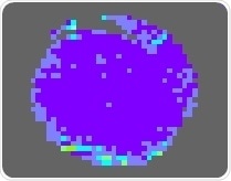 Alzheimer’s drug could be re-purposed to reverse blood vessel damage in diabetes