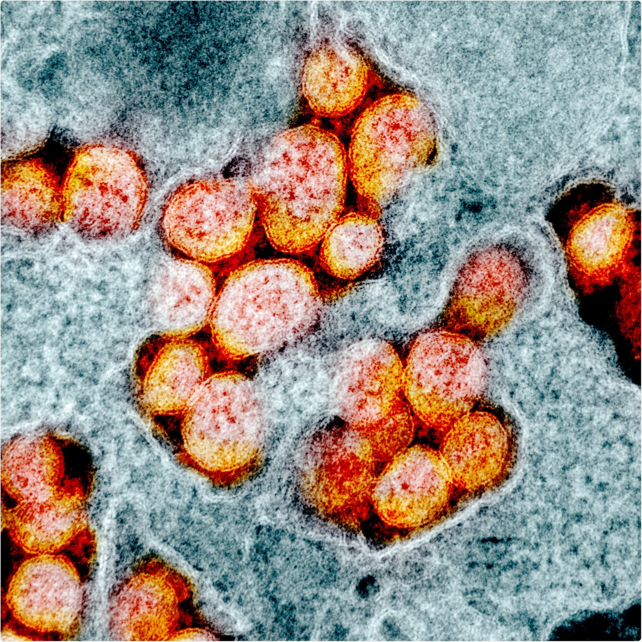 Transmission electron micrograph of SARS-CoV-2 virus particles, isolated from a patient. Image captured and color-enhanced at the NIAID Integrated Research Facility (IRF) in Fort Detrick, Maryland. Credit: NIAID