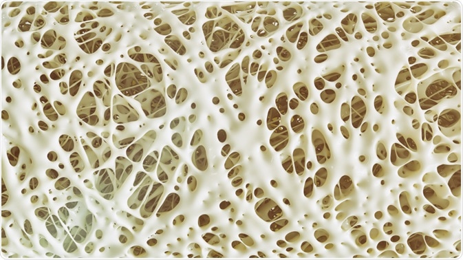 Osteoporosis Osteoporosis