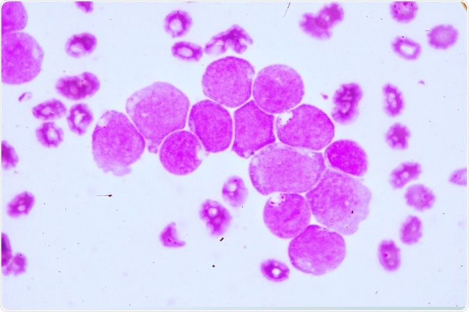 acute myeloid leukemia acute myeloid leukemia