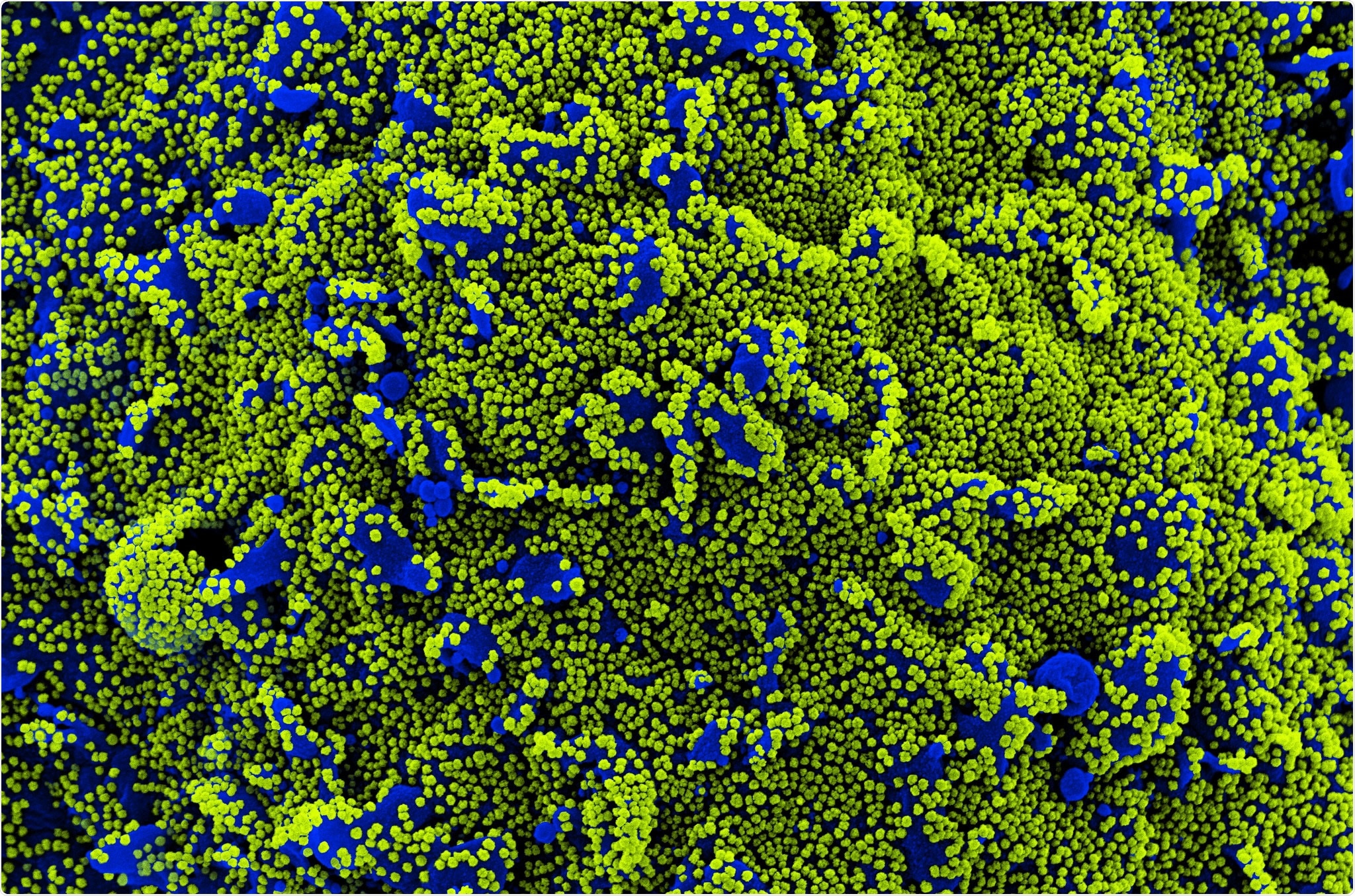 Study: Potent SARS-CoV-2 Neutralizing Antibodies Directed Against Spike N-Terminal Domain Target a Single Supersite. Image Credit: NIAID