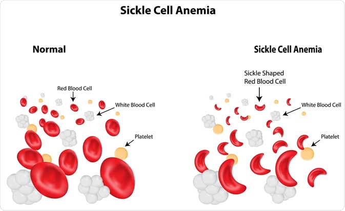 sickle cell