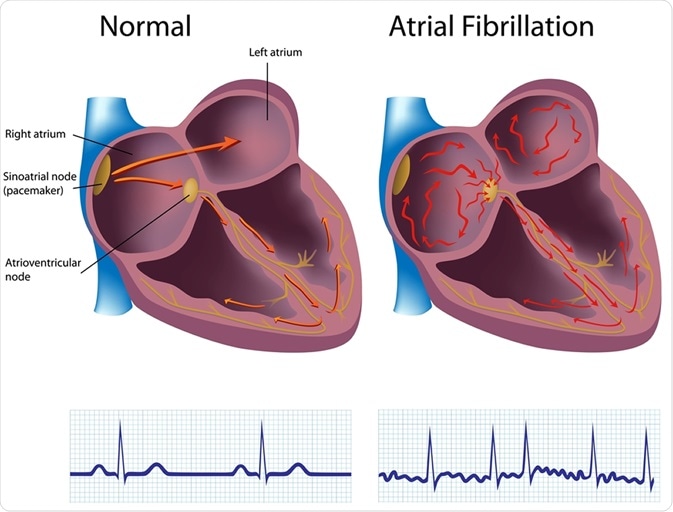 Atrial fibrillation. Image Credfit: Alila Medical Media / Shutterstock