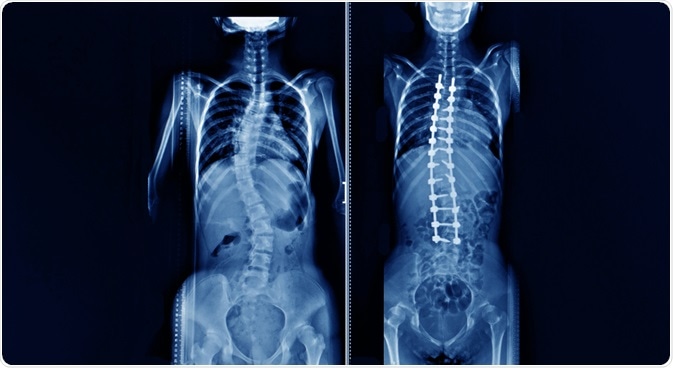 scoliosis