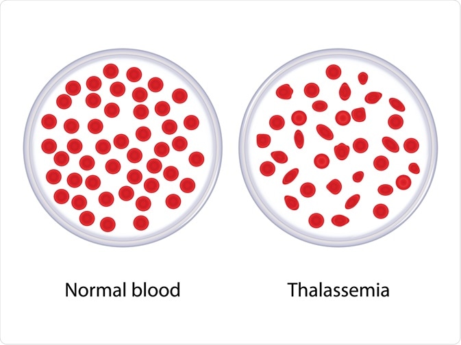 thalassemia
