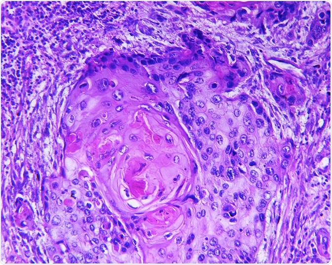 squamous cell carcinoma