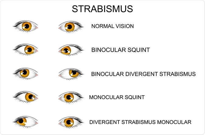 strabismus