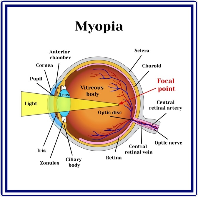 Diagram of myopic eye. Image Credit: Mrs_Bazilio / Shutterstock