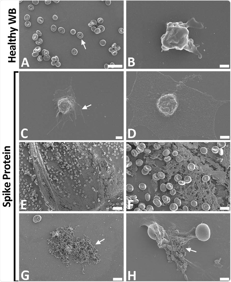 Representative scanning electron micrographs of healthy control whole blood (WB), with and without spike protein. A and B) Healthy WB smears, with arrow indicating normal erythrocyte ultrastructure. C to H) Healthy WB exposed to spike protein (1 ng.mL-1 final concentration), with C and D) indicating the activated platelets (arrow), E and F) showing the spontaneously formed fibrin network and G and H) the anomalous deposits that is amyloid in nature (arrows) (Scale bars: E: 20μm; A: 10μm; F and G: 5μm; H: 2μm; C: 1μm; B and D: 500nm).