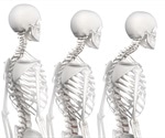 Kyphosis Treatment