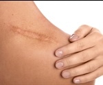 Preventing Scar Formation