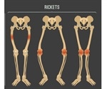 Rickets Symptoms