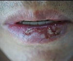 Actinic Cheilitis Diagnosis and Treatment