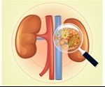 Pyelonephritis Treatments