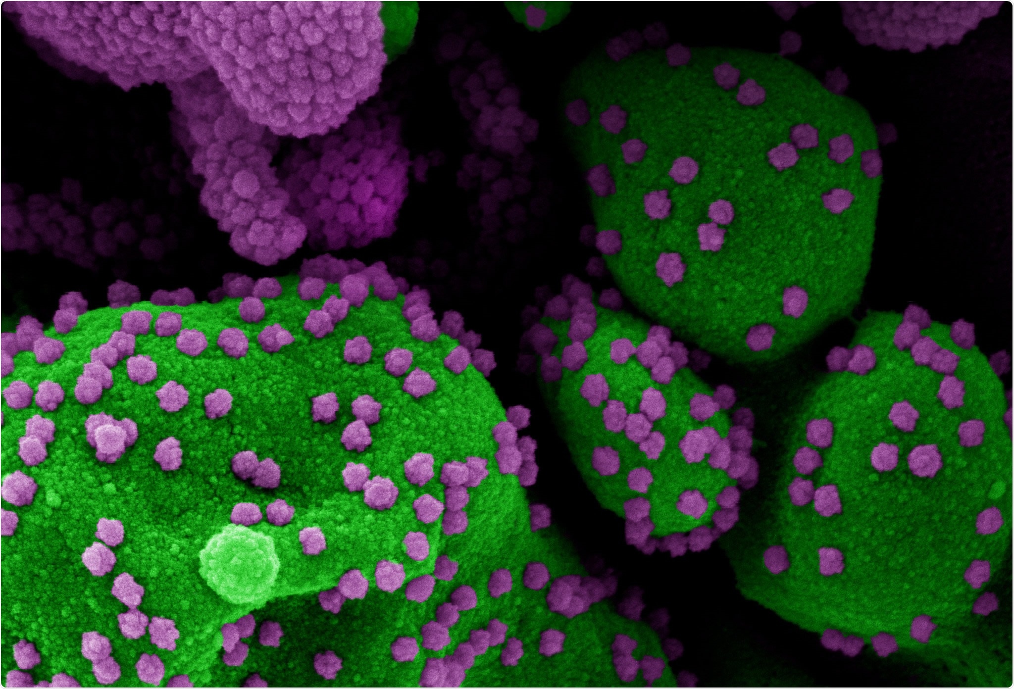 Study: COVID-19 susceptibility variants associate with blood clots, thrombophlebitis and circulatory diseases. Image Credit: NIAID