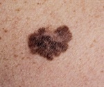 Melanoma Prognosis