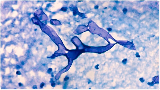 Mucormycosis