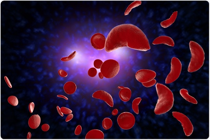 Sickle Cell Disease