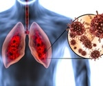 A closer look at how COVID-19 damages human lungs