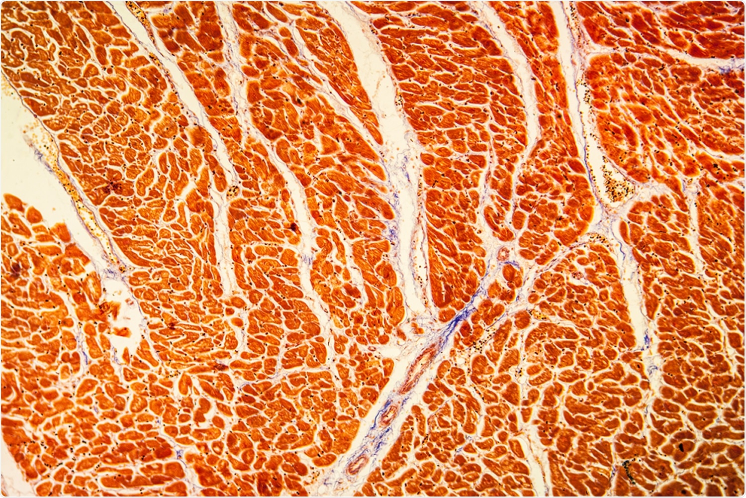 Myocarditis and Pericarditis Following mRNA COVID-19 Vaccination. Image Credit: Dr. Norbert Lange / Shutterstock