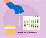 Proteinuria - High Level of Protein in Urine