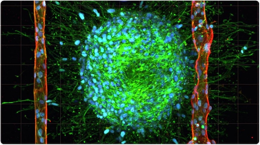 New 3D model of living brain cancer overcomes a major challenge in tissue engineering