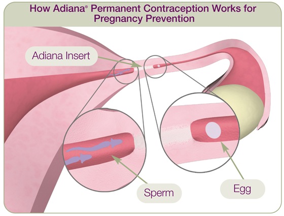 A tiny, soft insert is placed in each fallopian tube right where a low level of energy was applied. The tissue grows in and around the Adiana inserts which completely and permanently blocks the fallopian tubes to prevent pregnancy.