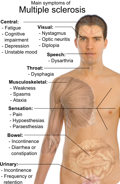 Multiple Sclerosis Symptoms Multiple Sclerosis Symptoms