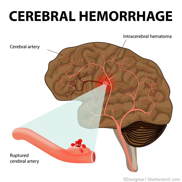 cerebral hemorrhage illustration