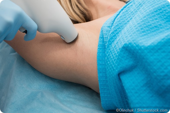 removing sweat glands radiation