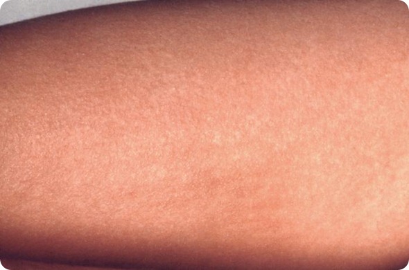 scarlet fever rash scarlet fever rash