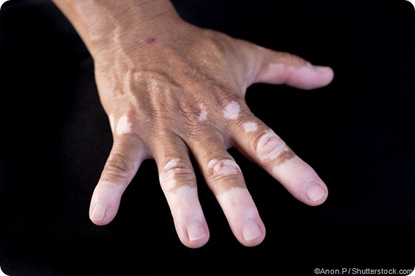 vitiligo on hand