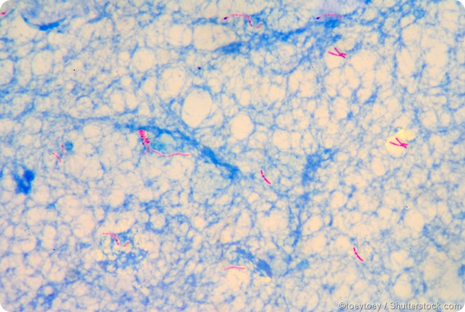 AFB stain show Micro bacterium tuberculosis (TB)