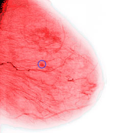 Progress toward development of a breast cancer vaccine has been reported by researchers at Washington University School of Medicine and the Siteman Cancer Center in St. Louis.